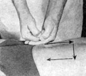 Рис. 70. Левую кисть тыльной стороной он накладывает на область аппендикса, а правой (тоже тыльной стороной) отягощает ее