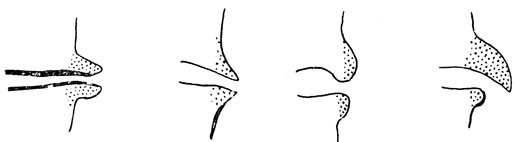 Рис. 24. Схематическое изображение различных вариантов задних экзостозов тел позвонков - 'шпор' (по Allen, 1952)
