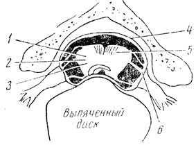 Рис. 25. Механизмы спинальной компрессии по Кану (1947). 1 - область, до которой распространяется сдавливающее действие диска; 2 - пирамидный тракт; 3 - спино-таламический тракт; 4 - твердая мозговая оболочка; 5 - задние столбы, защищаемые от компрессии зубчатыми связками; 6 - зубчатая связка
