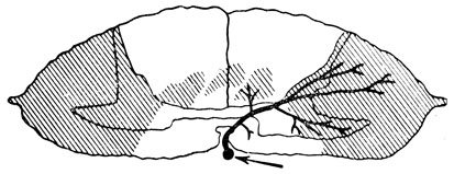 Рис. 26. Зоны поражения спинного мозга (заштрихованное) в связи с нарушением кровообращения в передней спинальной артерии (по Mair и Druckman, 1953). Стрелка - передняя спинальная артерия
