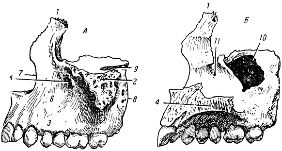Рис. 38. Верхняя челюсть. А - левая (вид снаружи); Б - правая (вид изнутри); 1 - лобный отросток; 2 - скуловой отросток; 3 - альвеолярный отросток; 4 - небный отросток; 5 - подглазничное отверстие; 6 - собачья ямка; 7 - носовая вырезка; 8 - верхнечелюстной бугор; 9 - подглазничная борозда; 10 - гайморова пазуха; 11 - слезная борозда