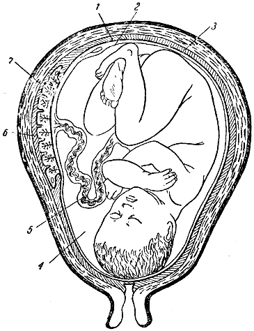 Рис. 90. Расположение оболочек зародыша в матке. 1 - хорион; 2 - амнион; 3 - децидуальная (отпадающая) оболочка; 4 - полость амниона, заполненная околоплодными водами; 5 - пупочный канатик; 6 - материнская часть плаценты; 7 - детская часть плаценты