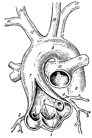 Рис. 108. Аорта и легочный ствол (часть). 1 - полулунные клапаны аорты; 2 - правая венечная артерия; 3 - отверстие правой венечной артерии; 4 - левая венечная артерия; 5 - отверстие левой венечной артерии; 6 - углубления (пазухи) между полулунными клапанами и стенкой аорты; 7 - восходящая аорта; 8 - дуга аорты; 9 - нисходящая аорта; 10 - легочный ствол; 11 - левая легочная артерия; 12 - правая легочная артерия; 13 - плече-головной ствол; 14 - правая подключичная артерия; 15 - правая общая сонная артерия; 16 - левая общая сонная артерия; 17 - левая подключичная артерия