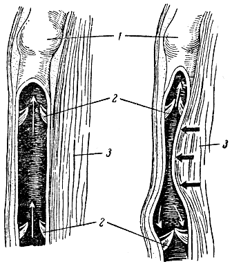 Рис. 115. Схема действия венозных клапанов. 1 - вена, нижняя часть которой вскрыта; 2 - венозные клапаны; 3 - мышца (слева расслаблена, справа сокращена). Черные стрелки показывают давление сократившейся мышцы на вену; белые стрелки - движение крови в вене