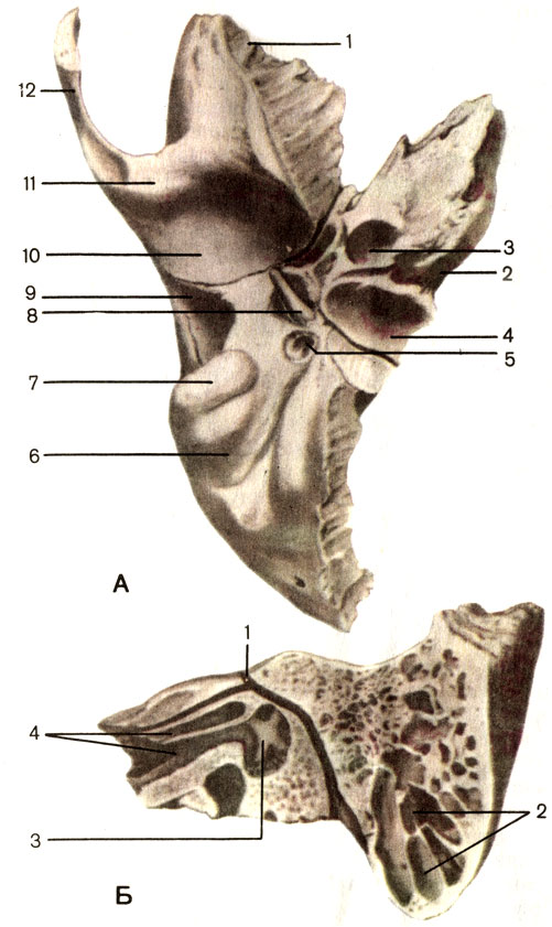 Рис. 53. Височная кость. А - вид снизу: 1 - чешуйчатая часть (pars squamosa); 2 - каменистая часть, или пирамида (pars petrosa); 3 - сонный канал (canallis caroticus); 4-яремная ямка (fossa jugularis); 5 - шилососцевидное отверстие (foramen stylomastoideum); 6 - сосцевидная вырезка (incisure mastoidea); 7 - сосцевидный отросток (processus mastoideus); 8 - шиловидный отросток (processus styloideus); 9 - барабанная часть (pars tympanica); 10 - нижнечелюстная ямка (fossa mandibulars); 11 - суставной бугорок (tuberculum articulare); 12 - скуловой отросток (processus zygomaticus). Б - вертикальный распил параллельно оси пирамиды: 1 - лицевой канал (canalis facialis); 2 - ячейка сосцевидного отростка; 3 - барабанная полость (cavitas tympanica); 4 - мышечно-трубный канал (canalis musculotubarius)